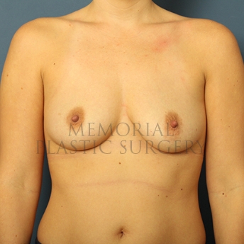 A front view before photo of patient 283 that underwent Breast Augmentation procedures at Memorial Plastic Surgery