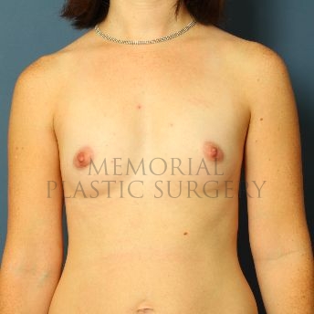 A front view before photo of patient 166 that underwent Breast Augmentation procedures at Memorial Plastic Surgery