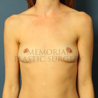 A front view before photo of patient 146 that underwent Breast Augmentation procedures at Memorial Plastic Surgery