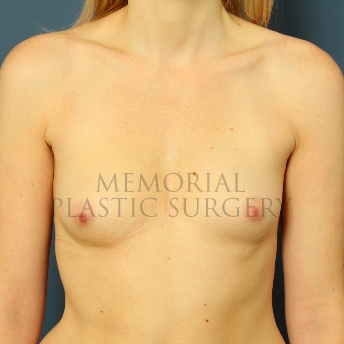 A front view before photo of patient 374 that underwent Breast Augmentation procedures at Memorial Plastic Surgery