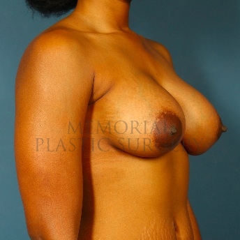 A oblique view after photo of patient 95 that underwent Breast Augmentation procedures at Memorial Plastic Surgery