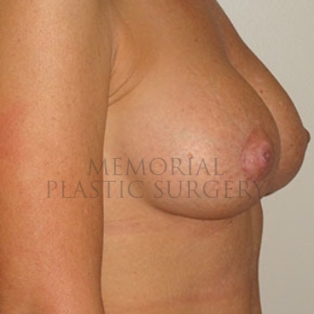 A oblique view after photo of patient 177 that underwent Breast Augmentation procedures at Memorial Plastic Surgery