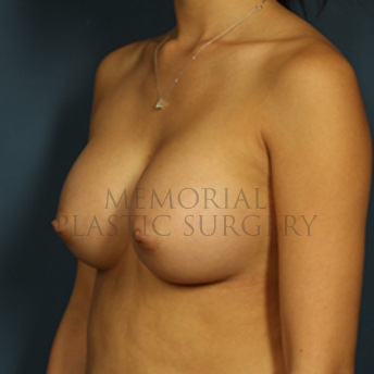 A oblique view after photo of patient 398 that underwent Breast Augmentation procedures at Memorial Plastic Surgery