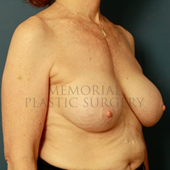 A oblique view after photo of patient 332 that underwent Breast Augmentation procedures at Memorial Plastic Surgery