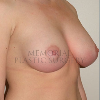 A oblique view after photo of patient 171 that underwent Breast Augmentation procedures at Memorial Plastic Surgery