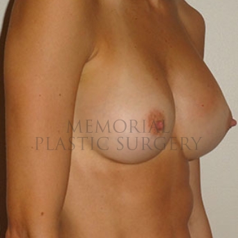 A oblique view after photo of patient 175 that underwent Breast Augmentation procedures at Memorial Plastic Surgery
