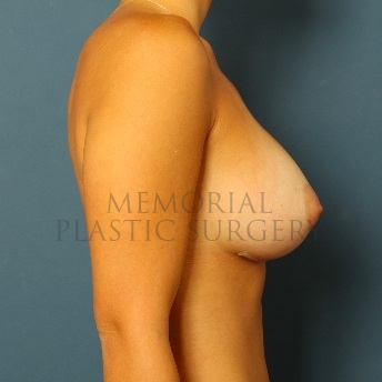 A oblique view after photo of patient 101 that underwent Breast Augmentation procedures at Memorial Plastic Surgery