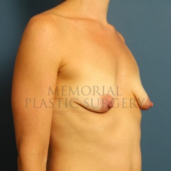 A oblique view before photo of patient 85 that underwent Breast Augmentation procedures at Memorial Plastic Surgery