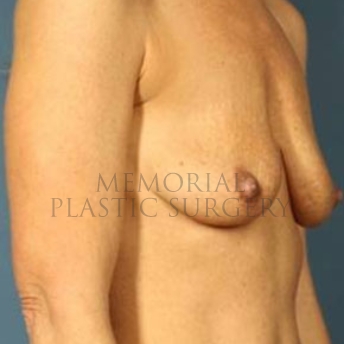 A oblique view before photo of patient 177 that underwent Breast Augmentation procedures at Memorial Plastic Surgery