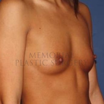 A oblique view before photo of patient 172 that underwent Breast Augmentation procedures at Memorial Plastic Surgery
