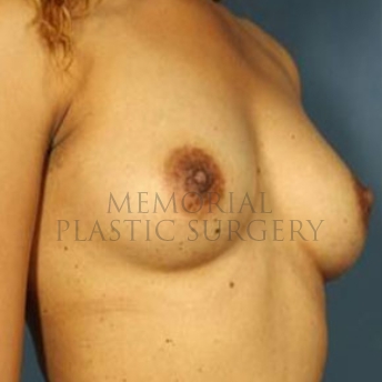 A oblique view before photo of patient 182 that underwent Breast Augmentation procedures at Memorial Plastic Surgery