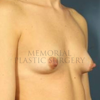 A oblique view before photo of patient 184 that underwent Breast Augmentation procedures at Memorial Plastic Surgery
