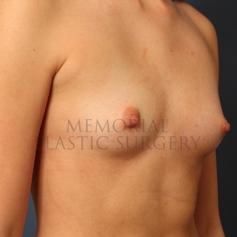 A oblique view before photo of patient 415 that underwent Breast Augmentation procedures at Memorial Plastic Surgery