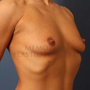A oblique view before photo of patient 423 that underwent Breast Augmentation procedures at Memorial Plastic Surgery
