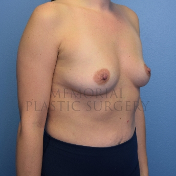 A oblique view before photo of patient 4101 that underwent Breast Augmentation procedures at Memorial Plastic Surgery