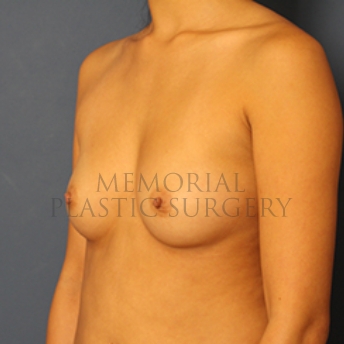 A oblique view before photo of patient 398 that underwent Breast Augmentation procedures at Memorial Plastic Surgery