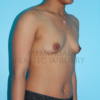 A oblique view before photo of patient 267 that underwent Breast Augmentation procedures at Memorial Plastic Surgery
