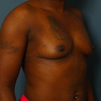 A oblique view before photo of patient 77 that underwent Breast Augmentation procedures at Memorial Plastic Surgery
