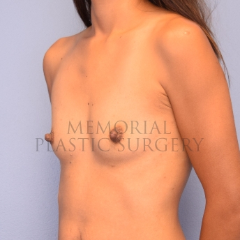 A oblique view before photo of patient 2411 that underwent Breast Augmentation procedures at Memorial Plastic Surgery