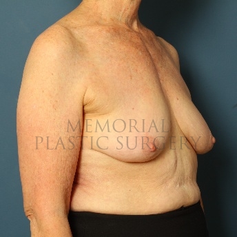 A oblique view before photo of patient 72 that underwent Breast Augmentation procedures at Memorial Plastic Surgery