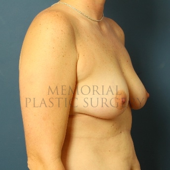 A oblique view before photo of patient 60 that underwent Breast Augmentation procedures at Memorial Plastic Surgery