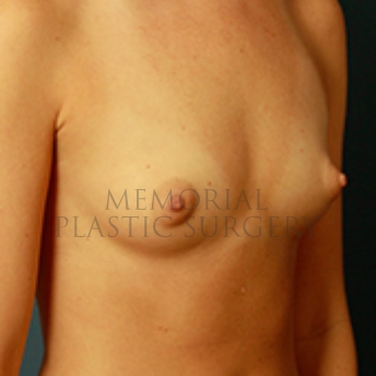 A oblique view before photo of patient 378 that underwent Breast Augmentation procedures at Memorial Plastic Surgery
