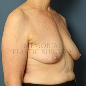 A oblique view before photo of patient 332 that underwent Breast Augmentation procedures at Memorial Plastic Surgery