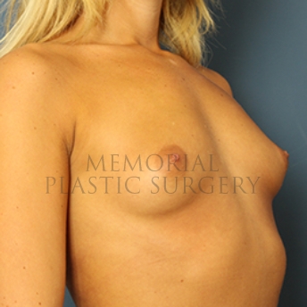A oblique view before photo of patient 343 that underwent Breast Augmentation procedures at Memorial Plastic Surgery