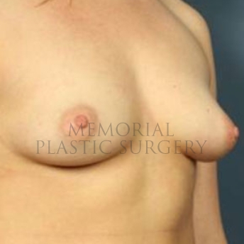 A oblique view before photo of patient 171 that underwent Breast Augmentation procedures at Memorial Plastic Surgery