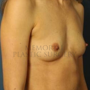 A oblique view before photo of patient 175 that underwent Breast Augmentation procedures at Memorial Plastic Surgery