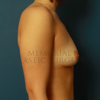A oblique view before photo of patient 101 that underwent Breast Augmentation procedures at Memorial Plastic Surgery
