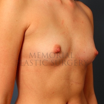A oblique view before photo of patient 110 that underwent Breast Augmentation procedures at Memorial Plastic Surgery