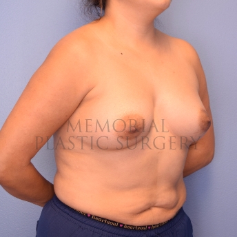 A oblique view before photo of patient 1257 that underwent Breast Augmentation procedures at Memorial Plastic Surgery