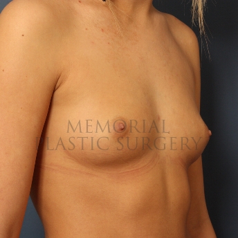 A oblique view before photo of patient 395 that underwent Breast Augmentation procedures at Memorial Plastic Surgery
