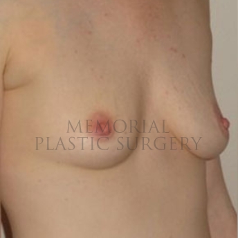 A oblique view before photo of patient 187 that underwent Breast Augmentation procedures at Memorial Plastic Surgery