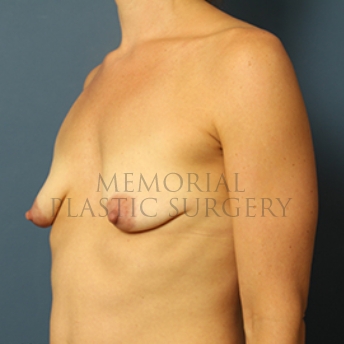 A oblique view before photo of patient 357 that underwent Breast Augmentation procedures at Memorial Plastic Surgery