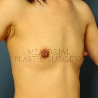 A oblique view before photo of patient 155 that underwent Breast Augmentation procedures at Memorial Plastic Surgery