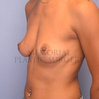A oblique view before photo of patient 1072 that underwent Breast Augmentation procedures at Memorial Plastic Surgery