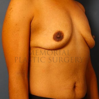 A oblique view before photo of patient 135 that underwent Breast Augmentation procedures at Memorial Plastic Surgery