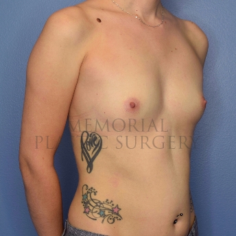 A oblique view before photo of patient 4100 that underwent Breast Augmentation procedures at Memorial Plastic Surgery