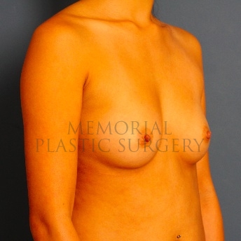 A oblique view before photo of patient 100 that underwent Breast Augmentation procedures at Memorial Plastic Surgery
