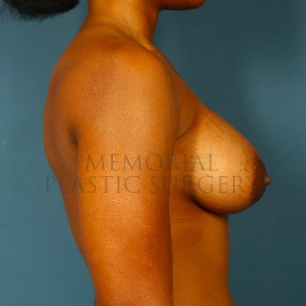 A side view after photo of patient 95 that underwent Breast Augmentation procedures at Memorial Plastic Surgery