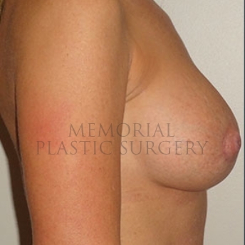 A side view after photo of patient 177 that underwent Breast Augmentation procedures at Memorial Plastic Surgery