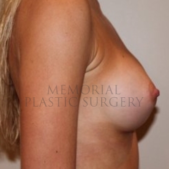 A side view after photo of patient 203 that underwent Breast Augmentation procedures at Memorial Plastic Surgery