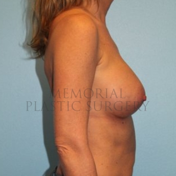 A side view after photo of patient 288 that underwent Breast Augmentation procedures at Memorial Plastic Surgery