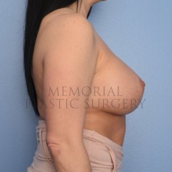 A side view after photo of patient 284 that underwent Breast Augmentation procedures at Memorial Plastic Surgery