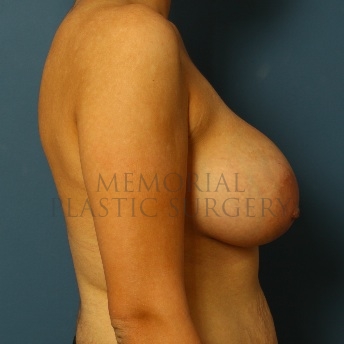 A side view after photo of patient 54 that underwent Breast Augmentation procedures at Memorial Plastic Surgery