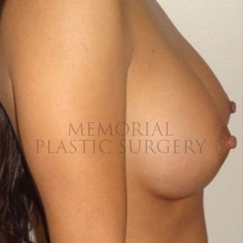 A side view after photo of patient 172 that underwent Breast Augmentation procedures at Memorial Plastic Surgery