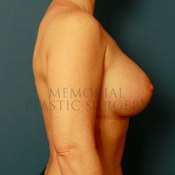 A side view after photo of patient 167 that underwent Breast Augmentation procedures at Memorial Plastic Surgery
