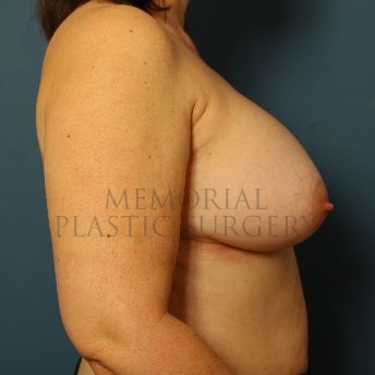 A side view after photo of patient 141 that underwent Breast Augmentation procedures at Memorial Plastic Surgery